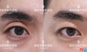 韩国爱丽克整形医院–双眼皮整形专科医院